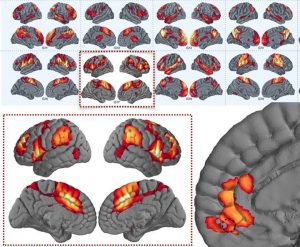 Connectome Depression recovery TMS